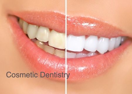 tooth whitening