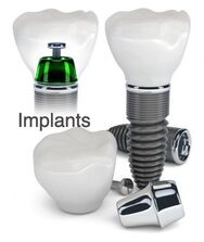 dental implant